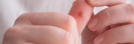 Une verrue ? 5 astuces naturelles pour vous en débarrasser enfin
